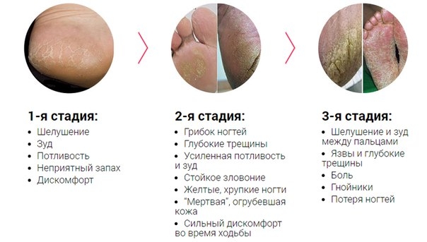 5 опасных ошибок при лечении грибка на ногах!