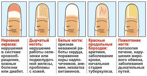 Определяем заболевания по ногтям Определяем заболевания по ногтям