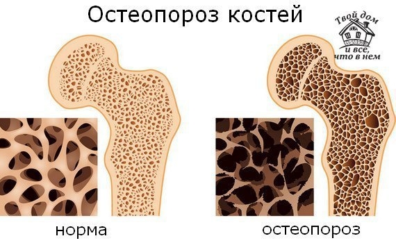 Эффективнейший бальзам при переломах, лечении остеопороза Эффективнейший бальзам при переломах, лечении остеопороза