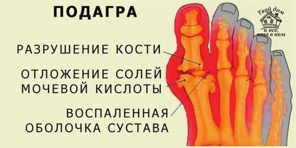 ЕСЛИ ЗАМУЧИЛА ПОДАГРА
